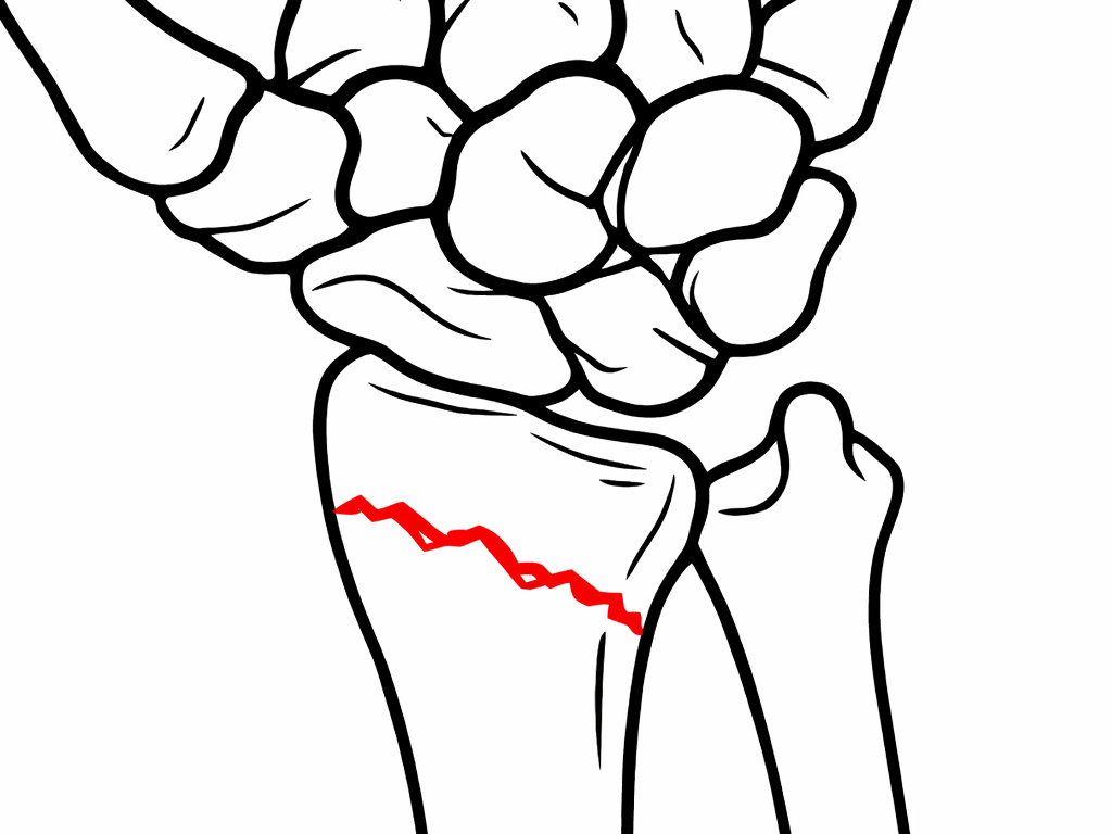 Mimokloubní zlomenina distálního radia