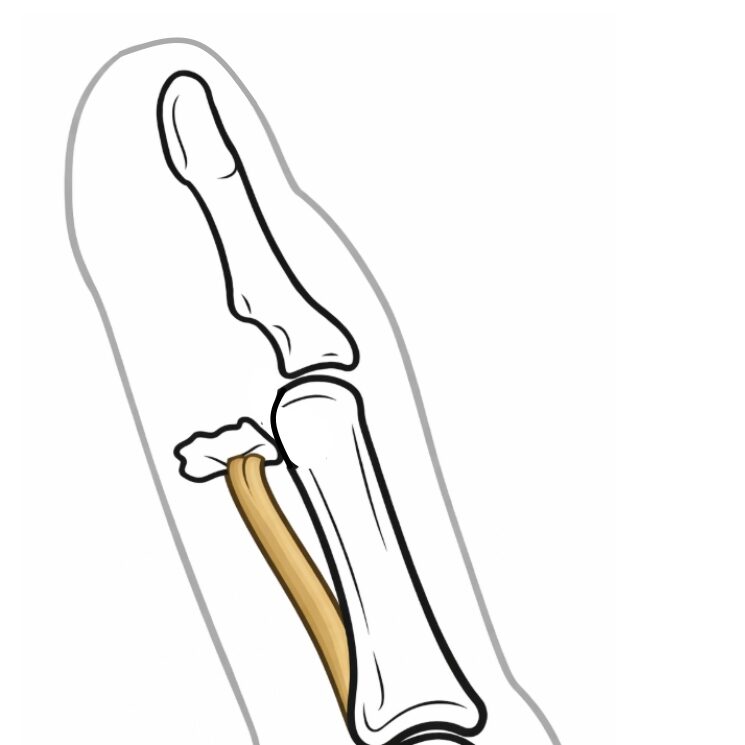 Jersey finger, avulze hlubokého ohýbače prstů