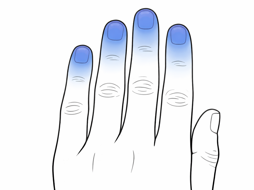 Raynaudova choroba